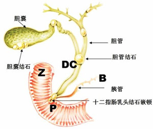 治疗胆总管结石需要多少钱(图1)