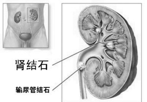 肾结石手术多少钱(图1)