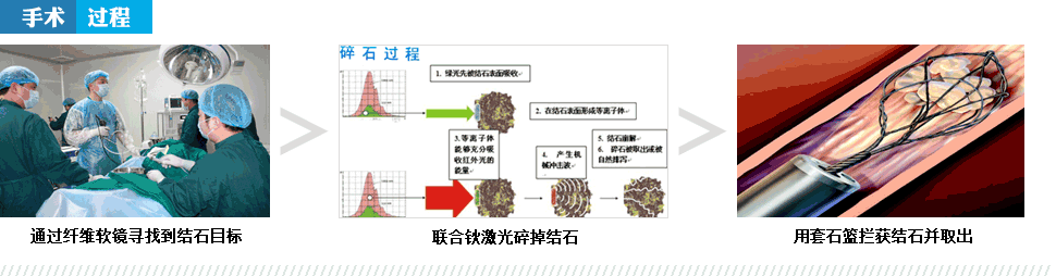 肾结石怎么排出(图1)