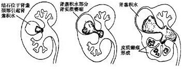 浅谈肾积水(图5)