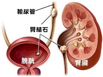 肾结石疼痛时怎么办(图1)