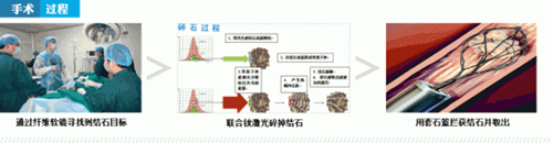 肾结石积水怎么办(图2)