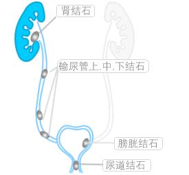 打肾结石要多少钱(图1)