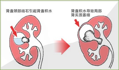 专家在线解答：肾积水严重吗？(图1)