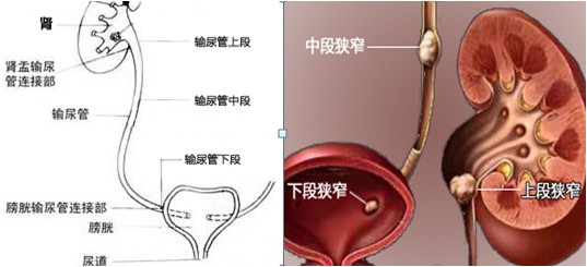 专家解答：输尿管结石是由什么病因引起的?(图1)