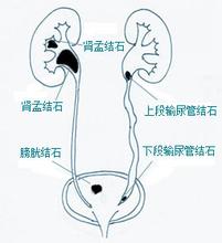 解析肾结石(图1)