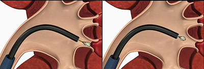 纤维软性肾镜取石—不开刀 保肾取石更安心(图1)