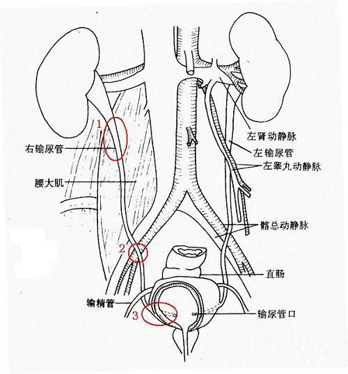 输尿管结石治疗大概要多少钱(图1)