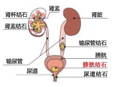 了解膀胱结石的症状 治疗不走误区(图1)