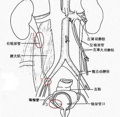 输尿管上段结石如何治疗(图4)