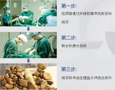 小肾结石怎么治?(图2) 小肾结石怎么治?(图2)