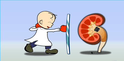 肾结石体外碎石危害(图1) 肾结石体外碎石危害(图1)