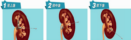 肾结石体外碎石危害(图2) 肾结石体外碎石危害(图2)
