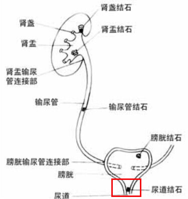 尿结石的症状及危害你了解多少？(图3)