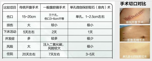 什么因素会诱发胆囊息肉呢？(图4)