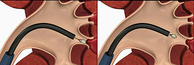 解析肾结石(图5) 解析肾结石(图5)