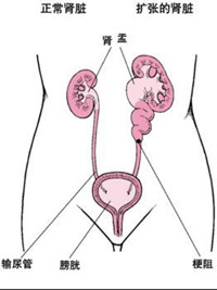 肾结石的并发症有哪些?(图1) 肾结石的并发症有哪些?(图1)