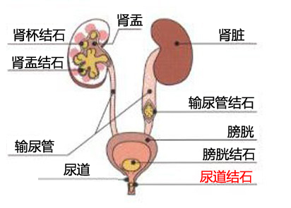 尿道结石患者诊断(图1)