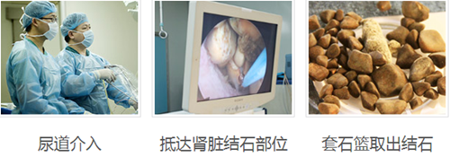 关于肾结石不得不知道的几件事(图5) 关于肾结石不得不知道的几件事(图5)