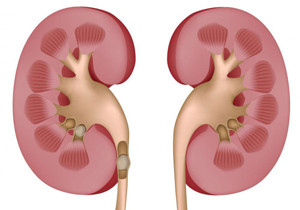 引起肾结石的原因是什么(图1) 引起肾结石的原因是什么(图1)