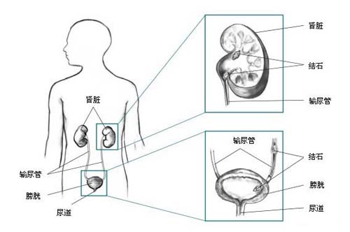 尿结石症状介绍，让您可以自我检测！(图1)