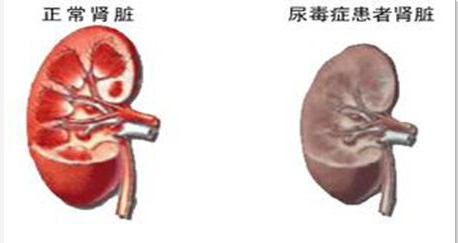 肾结石怎么办(图1)