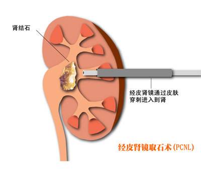 肾结石专业治疗——精、准、快(图5)