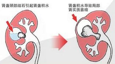 推荐——肾结石的治疗方法，不再迷茫了(图1)