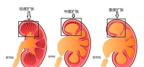 专家在线解答：肾积水严重吗？(图1)