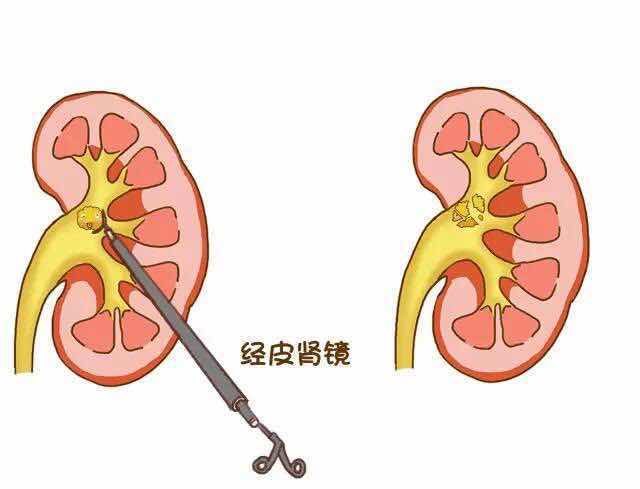 肾结石的检查方法有哪些？(图4)