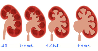 这个办法有效治疗输尿管结石伴肾积水(图1)