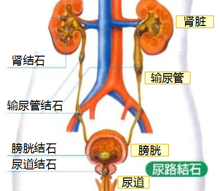 尿结石到底是什么？(图1)