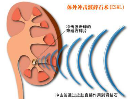 排出尿结石，其实很简单(图2)