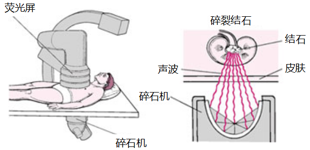 这些因素竟是导致尿结石形成的原因！(图2)