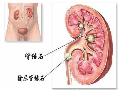 输尿管结石的这些知识，你需要了解(图1)