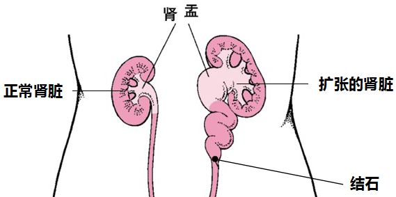 输尿管结石的这些知识，你需要了解(图3)