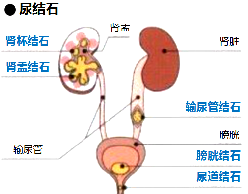 这些尿结石症状你有吗？注意身体发出的警告(图1)