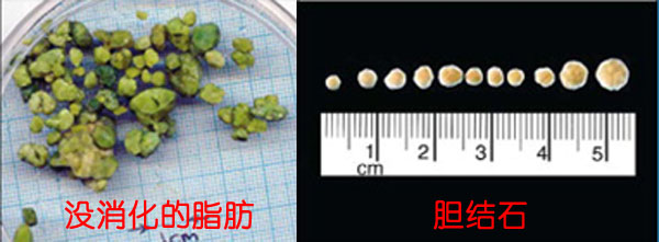 那么多排胆结石的方法，有没有靠谱的？(图1)