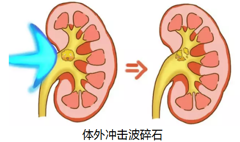 吃药、碎石、微创排尿结石，看看你适合哪种(图2)