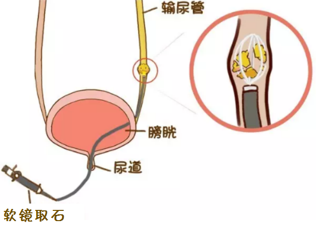 一步到位，解决输尿管结石伴肾积水(图2)