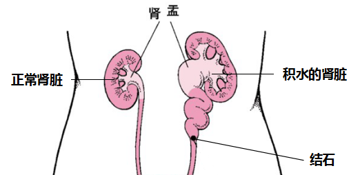 解析：原来输尿管结石是这么来的(图3)