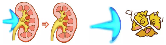 输尿管结石痛？一个小妙招有效缓解它(图3)