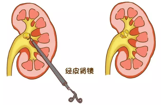 全面解析尿结石的各类手术(图3)