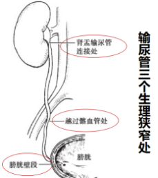 你想了解的输尿管结石知识，这里都有！(图1)