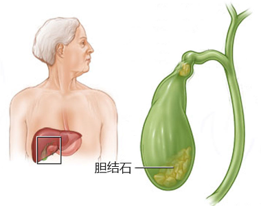 胆结石不一定要手术，但一定不能盲目乱治(图1)