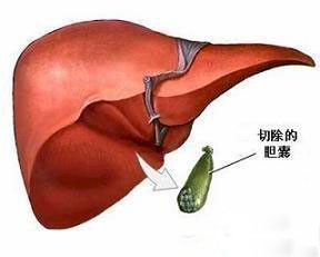 【详解】胆结石治法之一：胆囊切除手术(图1)