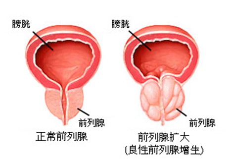 这些人易得膀胱结石，看看你中招没！(图1)