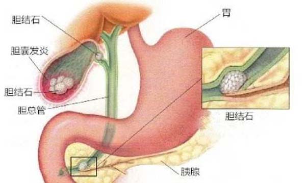 一分钟了解胆囊炎(图1)