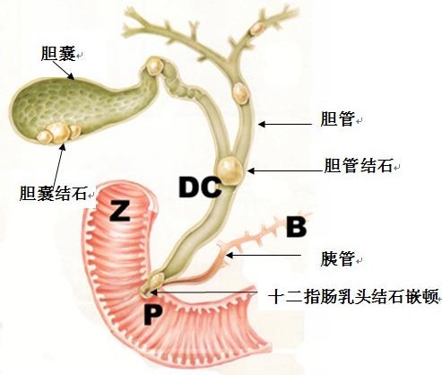 畅谈胆结石——你一定要知道的几件事(图1)